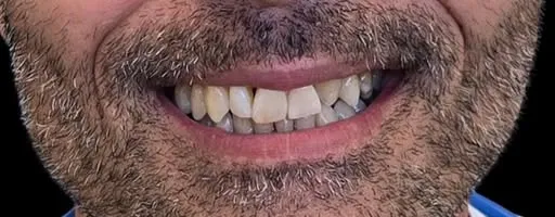 Prima del trattamento: sorriso con denti irregolari e più scuri