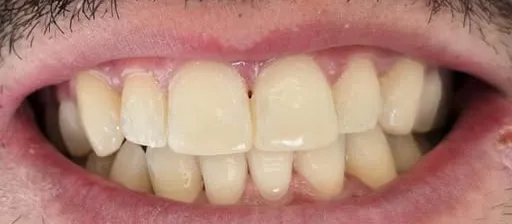 Dopo: denti allineati, con i bordi dei due incisivi centrali ricostruiti