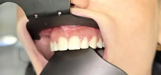 Gli stessi denti allineati e ricostruiti, dopo il trattamento.