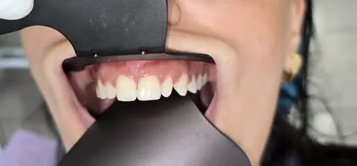 Denti frontali di una donna con il divaricatore, con un laterale fuori posizione, prima del trattamento.
