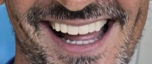 Dopo: denti regolari e più chiari