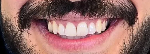 Dopo: denti allineati e livellati