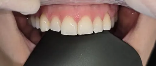 Prima del trattamento: denti frontali superiori in primo piano