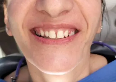 Prima del trattamento: sorriso con uno spazio tra gli incisivi centrali superiori